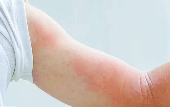 典型荨麻疹皮损为剧烈瘙痒的红斑,风团,有时伴血管性水肿.