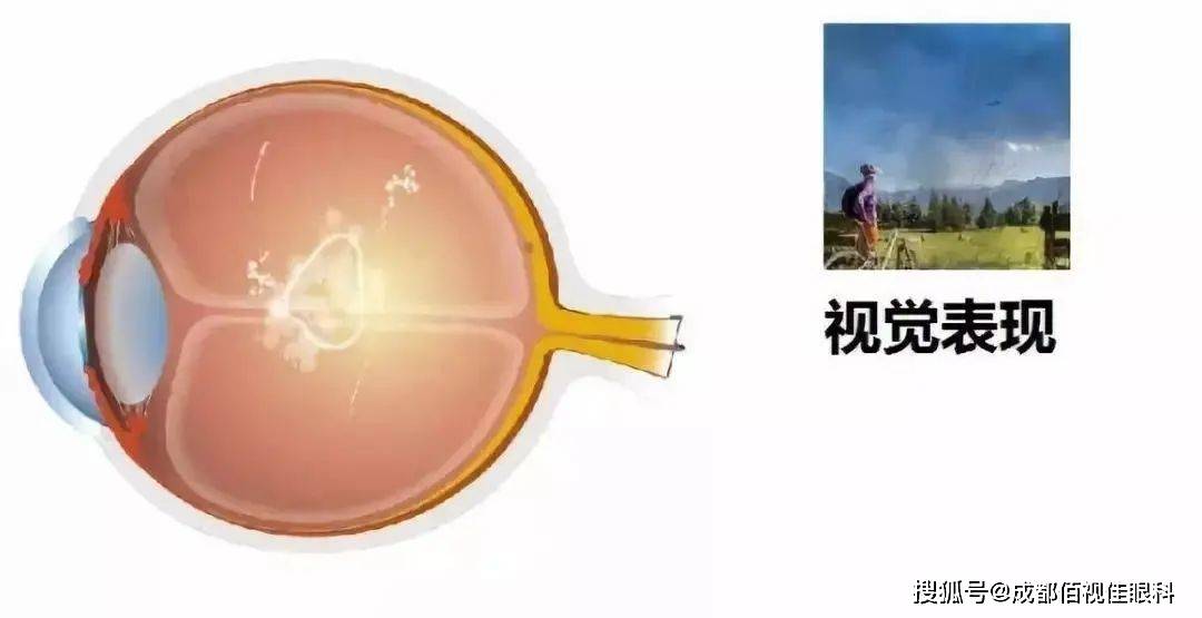飞蚊症