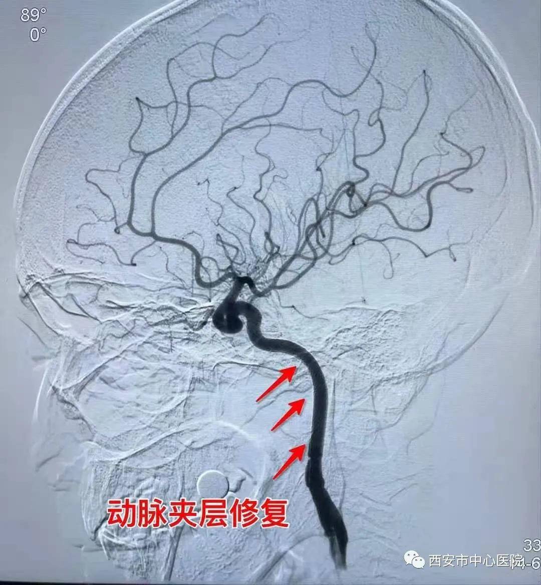 惊男子扛树险丧命原是颈动脉夹层惹的祸