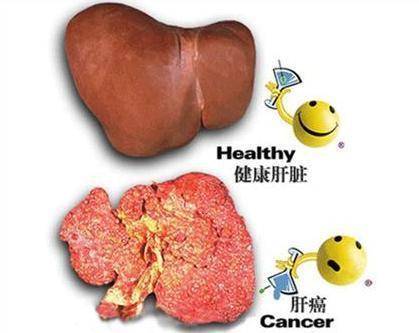 如果出现这7种身体异常,请尽快检查肝脏,忽视不得!