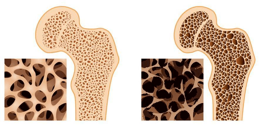 配图:正常骨(左)和骨质疏松(右)