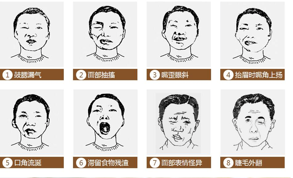 济南国医堂医院周振敏介绍:面瘫前的几个征兆