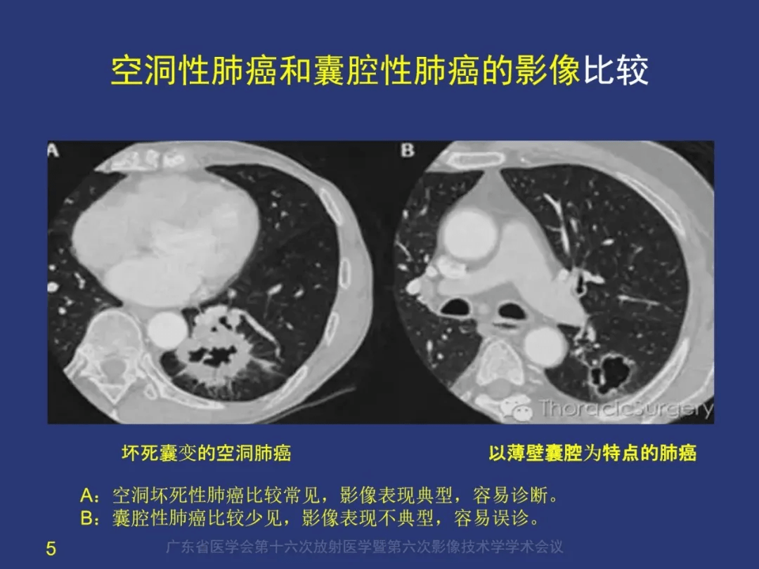 囊腔性肺癌如何诊断空洞性肺癌