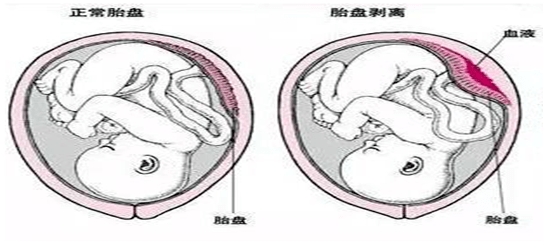 妊娠20周后或在分娩期时,原本处在正常位置的胎盘在胎儿娩出之前,有