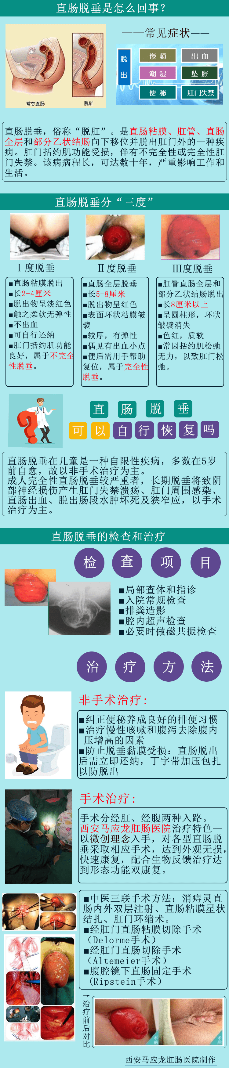 西安马应龙肛肠医院:直肠脱垂的手术治疗