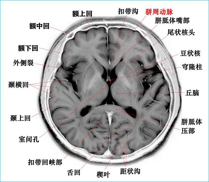 【t2wi反相图学 标本】高清颅脑断层解剖