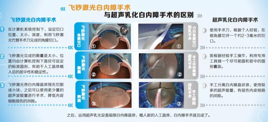 白内障手术中的高科技-飞秒激光白内障手术