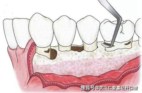 之外还有龈下刮治术,根面平整术.这个需要在局麻下进行.