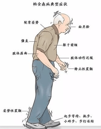 原创帕金森病的药物治疗