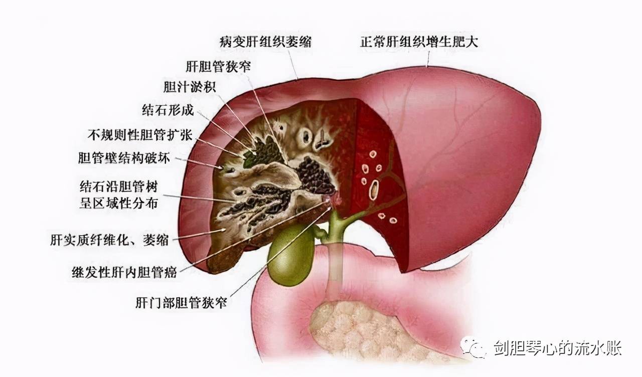 长期肝内胆管结石须警惕胆管癌