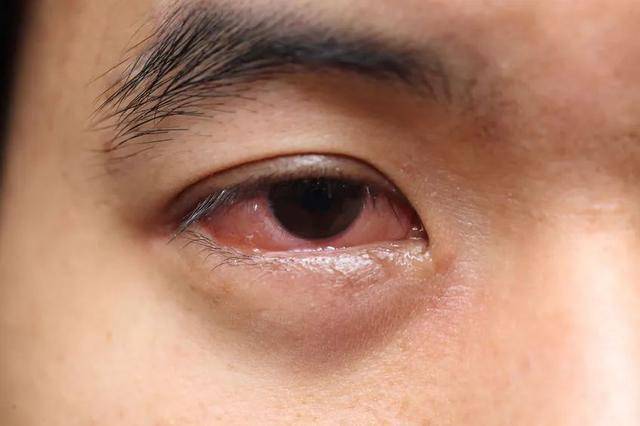 原创"揉眼睛"惹出惊人大祸——视网膜脱离失明!大人孩子都中招