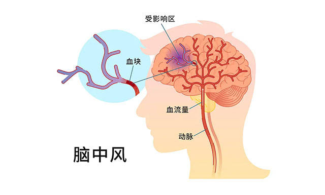 蓝十字脑科|球迷熬夜看球突发脑梗,专家提示:把握溶栓黄金时间4-5