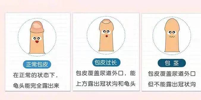 包皮过长和包茎的主要区别在于,包皮能不能翻开.