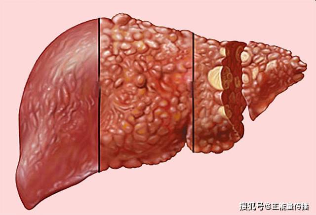 肝癌前期"不痛不痒"!如出现"1痒2臭3黑",及时查肝脏