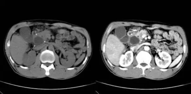 "已经做了普通ct,为什么还要我做增强ct?