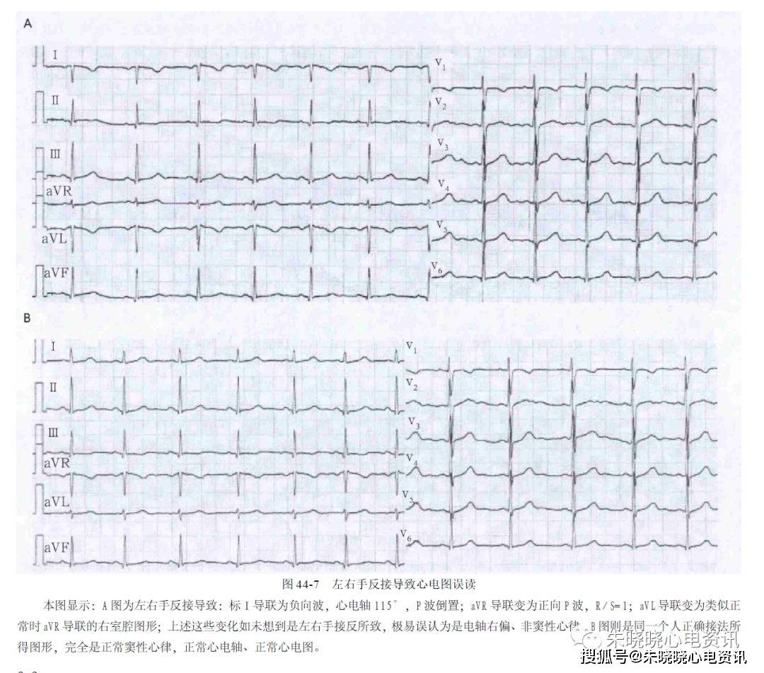 有时导联接法正确但心电图仍然出现违反规律的趋势, 要注意是否存在