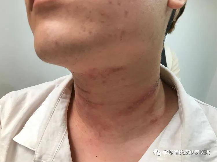 隐翅虫皮炎,这个季节要小心哦!