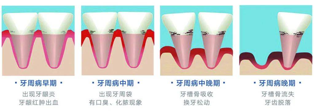 牙周疾病是指牙齿周围支持组织所患的各种疾病,包括牙龈炎和牙周炎.