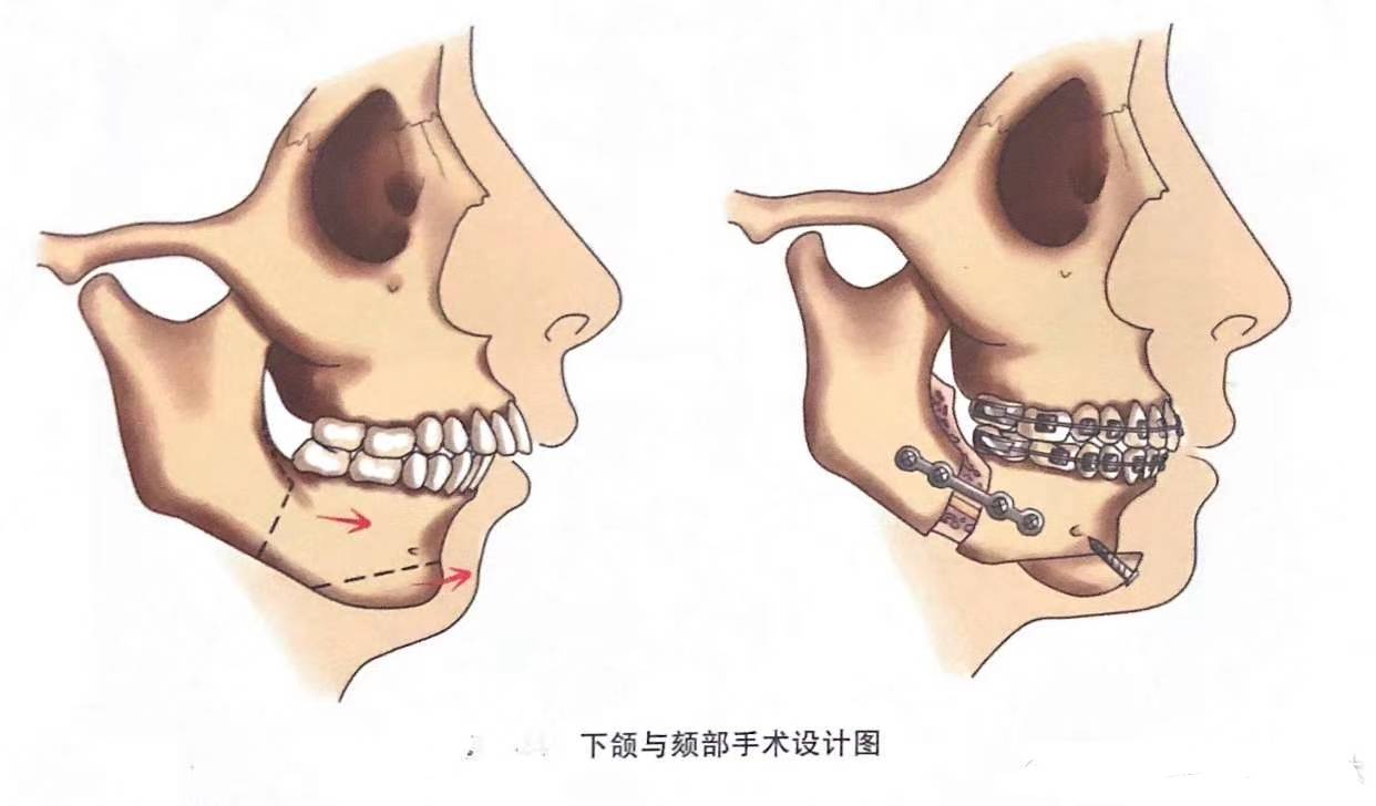 什么是下颌矢状骨劈开shu?