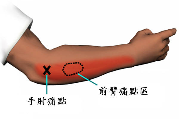 肱骨外上髁炎治疗方法