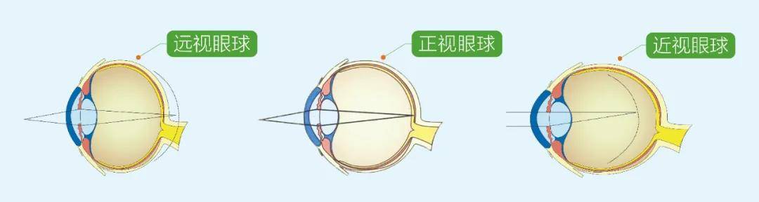 如果其中任何一项发生变化,就可能造成屈光不正,导致  近视,远视
