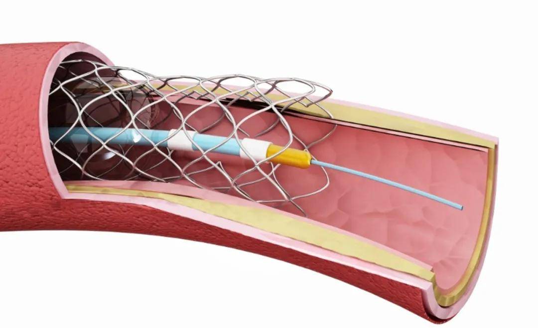 心脏支架进口,国产怎么选才合适?