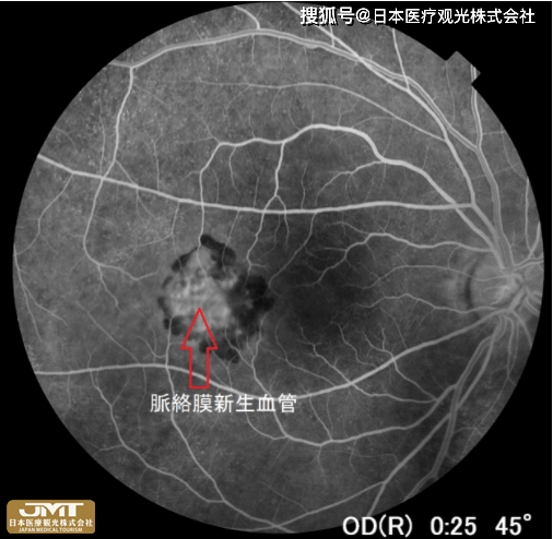 jmt日本医疗-脉络膜新生血管原因是什么?怎么治?