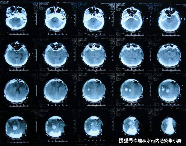 术后次日查头颅ct示双侧去骨瓣术后( 图-4).