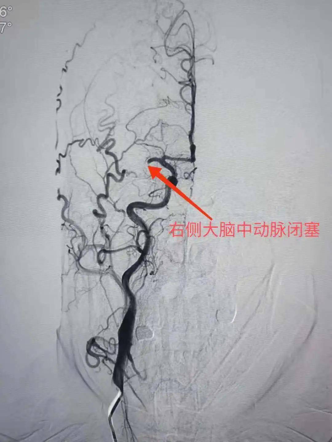 脑病科成功完成第一例脑动脉取栓手术,今后此类手术将