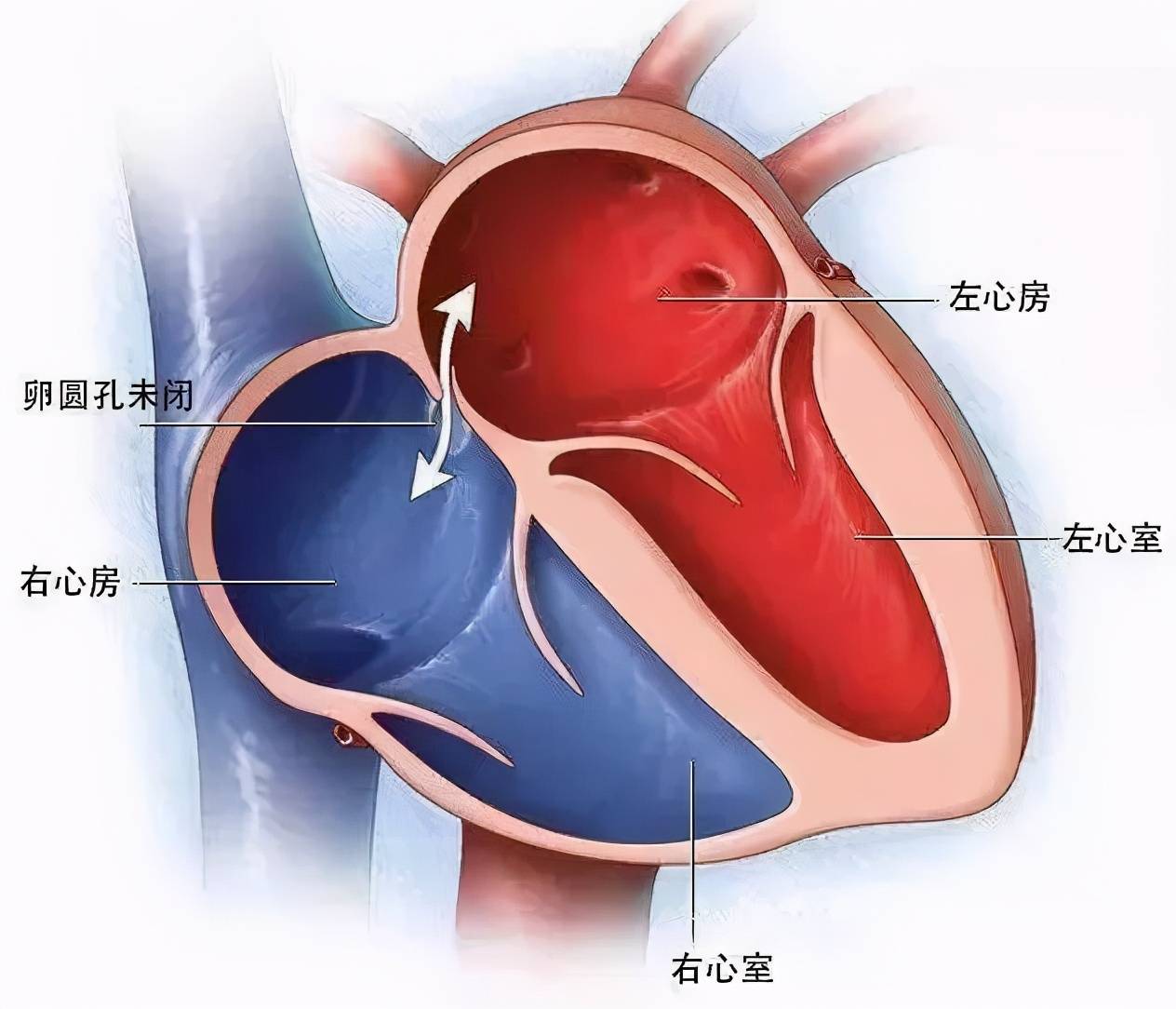 什么是卵圆孔未闭?