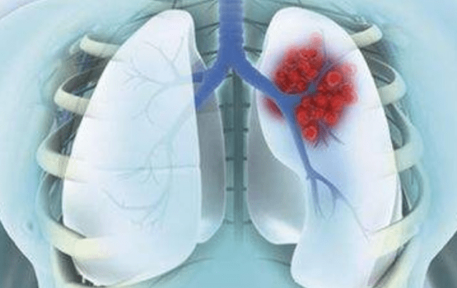 原创肺癌早期通常不痛不痒,身体若发现3个"信号",或许是肺在"求救"!