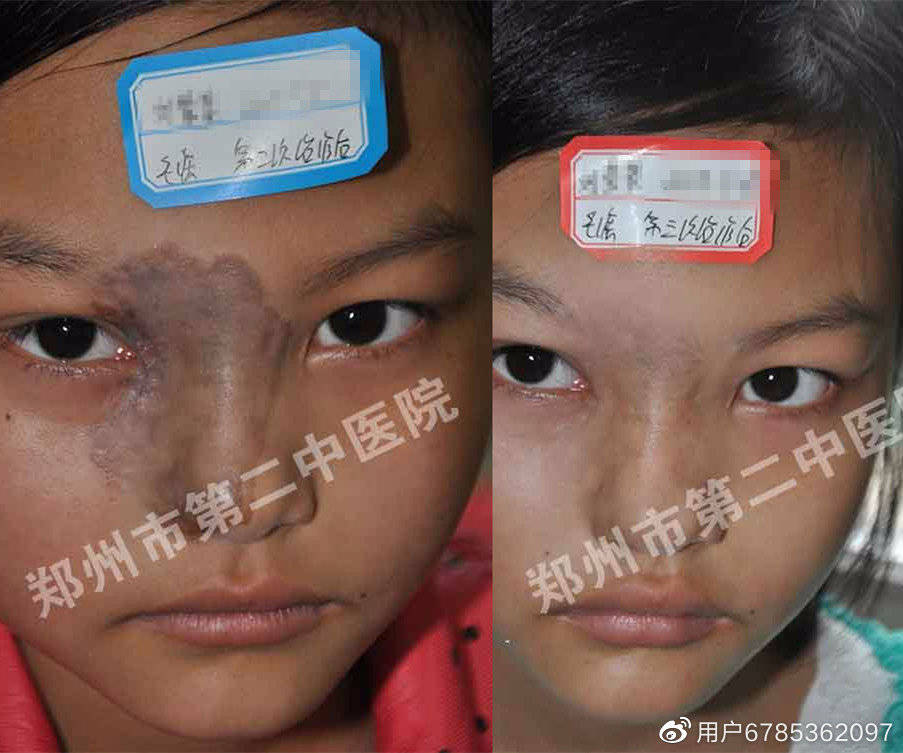 郑州市第二中医院:黑胎记是怎么形成的?