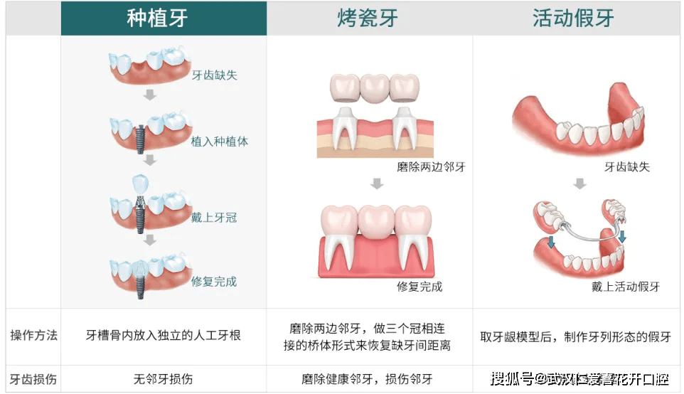 你还在以为缺牙没事儿吗?种植医师表示:90%的人看完后悔了!