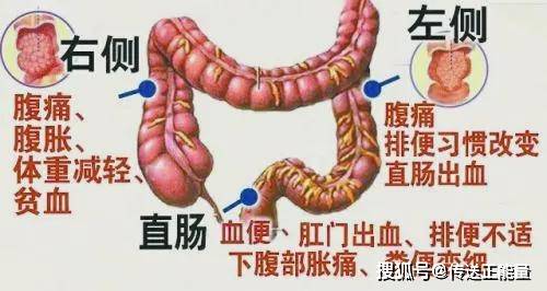 自然会有很大的几率会诱发大肠癌.