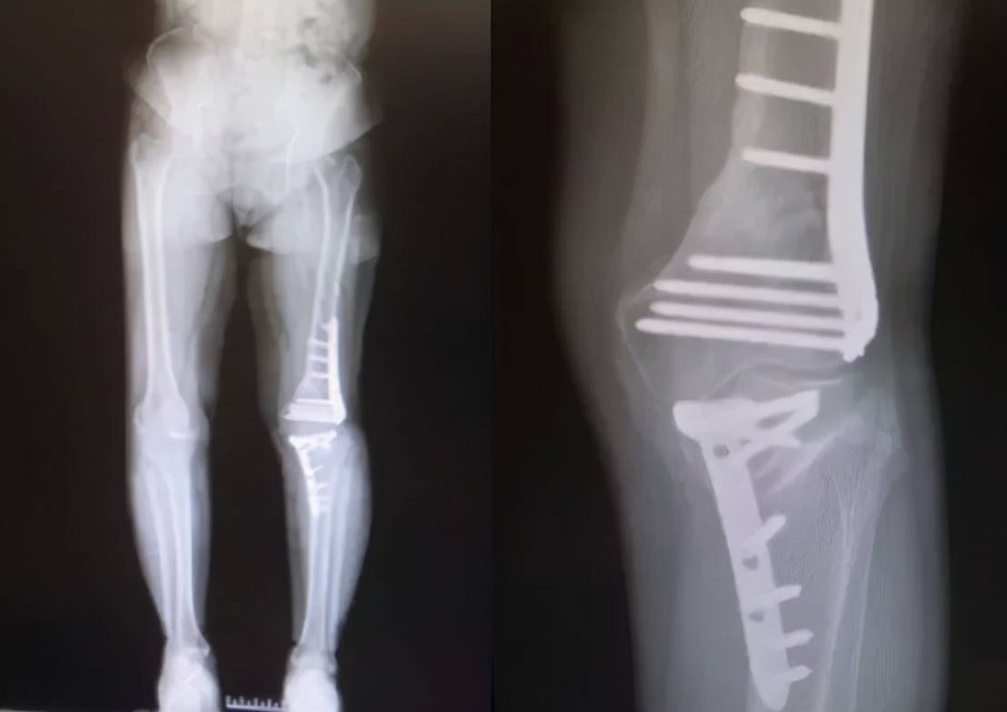 股骨和胫骨双部位截骨拯救复杂膝关节内翻畸形