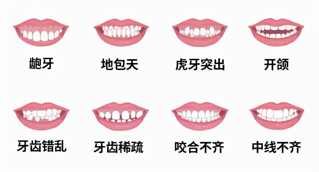 常见的牙颌畸形类型