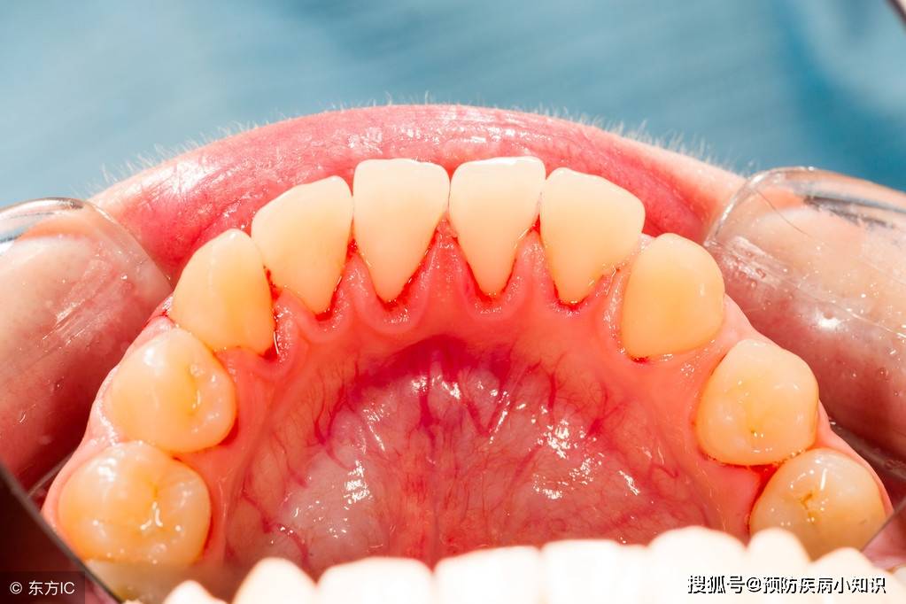肝癌早期的病人尤其肝脏功能受到损伤,也会导致牙龈出血.