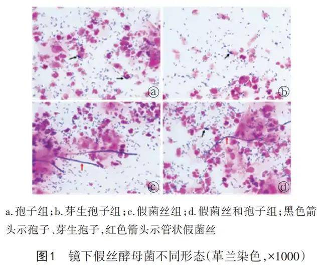 派特灵科普真菌在外阴阴道假丝酵母菌病诊治中的价值探讨