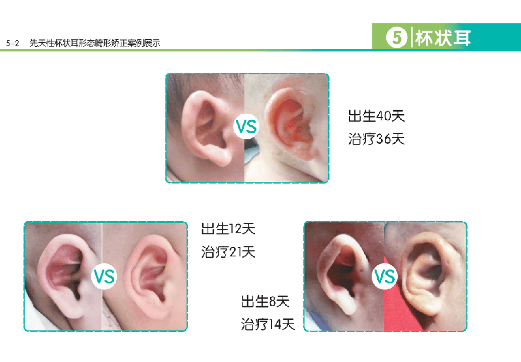 为什么先天性新生儿会出现耳廓畸形是什么原因导致的