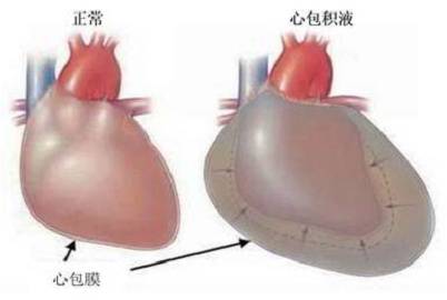 心包积液