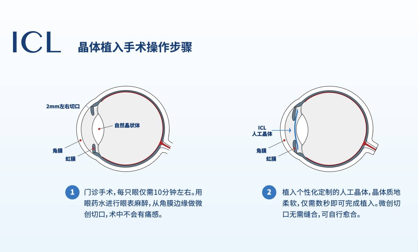 上海做icl最好的医院:如何选择晶体植入手术医院和医生?