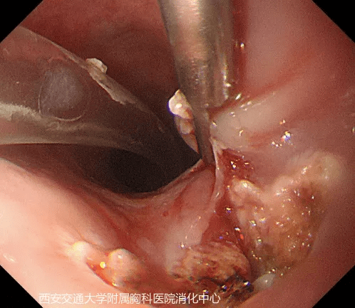 建立生命通道内镜下缝合轻松解决食管气管瘘