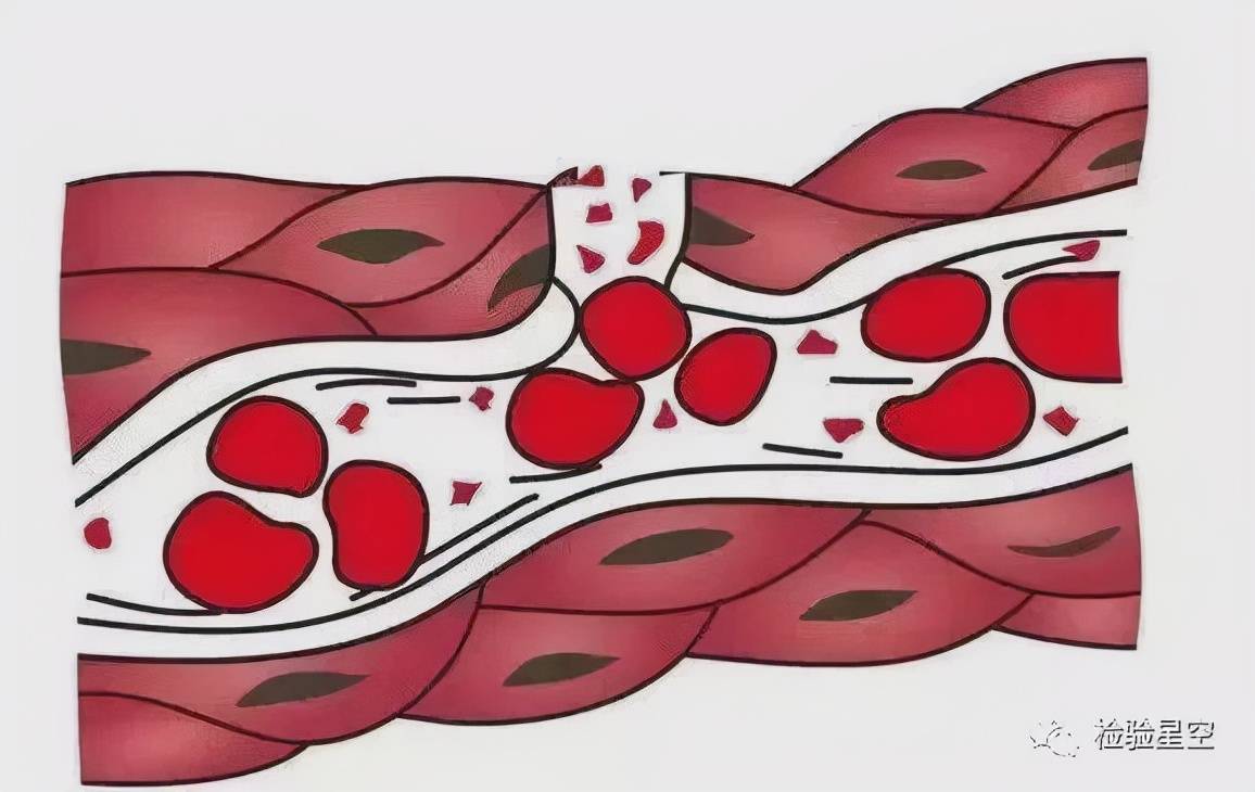 血小板附着于血管壁并凝集成块,以达初步止血作用 4,凝血