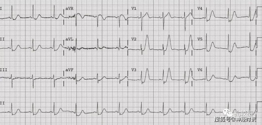 一图详解:急性心肌梗死的判读_灌注_心电图_回降