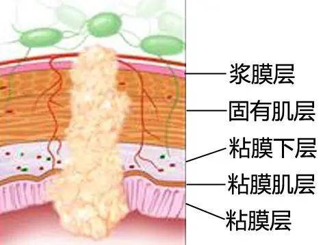 肠镜检查结果是上皮内瘤变,是肠癌的危险信号!