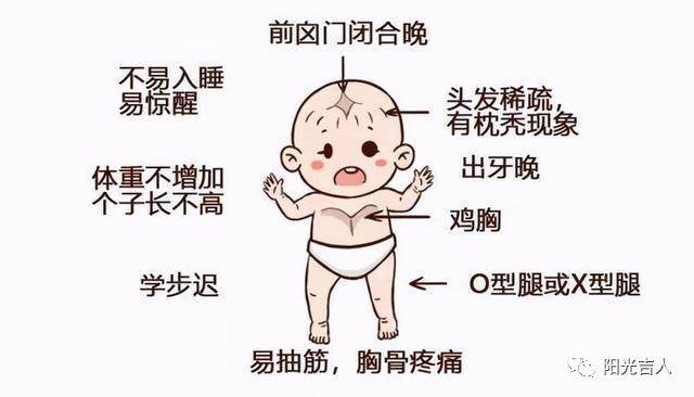 儿童常见营养性疾病之佝偻病