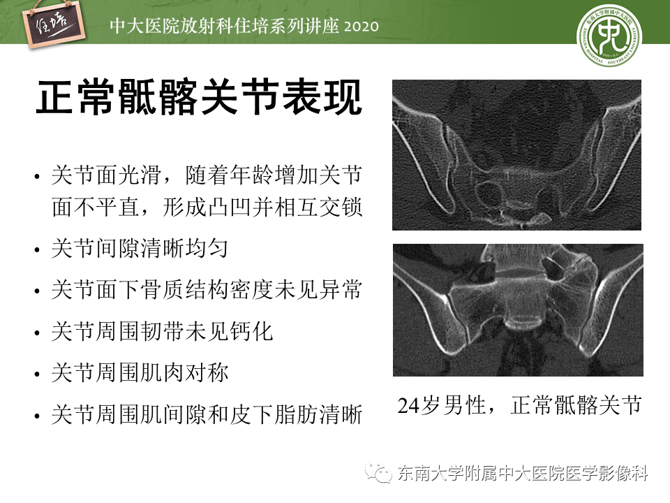 常见骶髂关节病变的影像表现