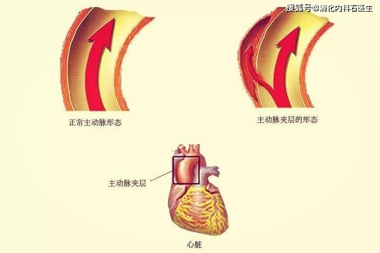 急性主动脉夹层是主动脉腔内的血液通过内膜破裂进入主动脉壁中层形成