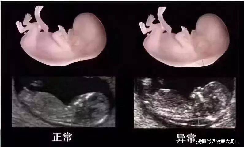 什么是nt检查孕妈咪一定要懂的第一次胎儿排畸