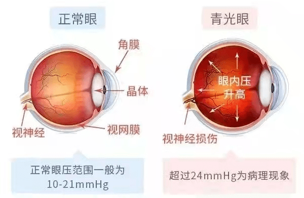 突然的眼压升高导致的急性青光眼,影响着植物神经和胃肠神经.